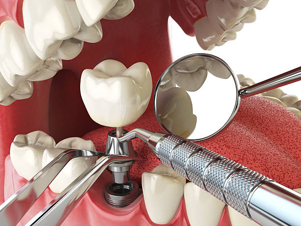 Best Emergency Dentist for Knocked-Out Tooth in Wyldwood, TX